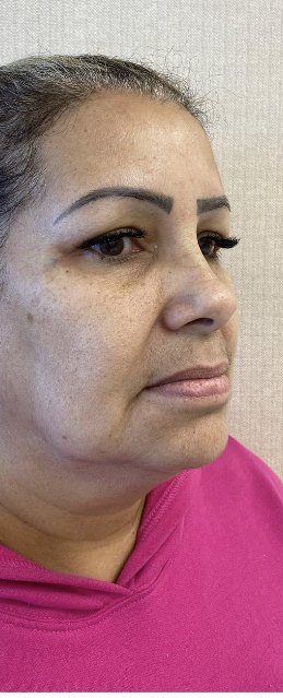 Antes da harmonização facial