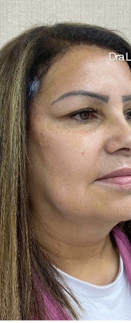 Depois da harmonização facial