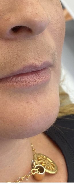 Antes do preenchimento labial
