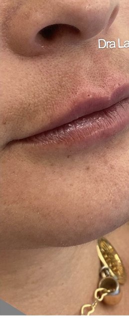 Depois do preenchimento labial