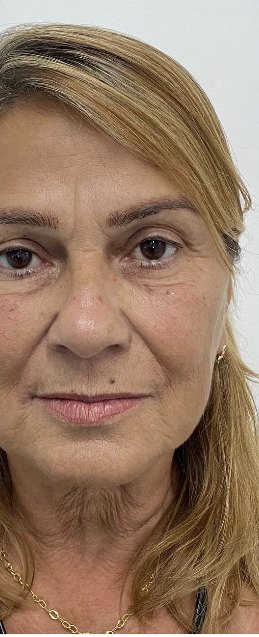 Antes do rejuvenescimento facial