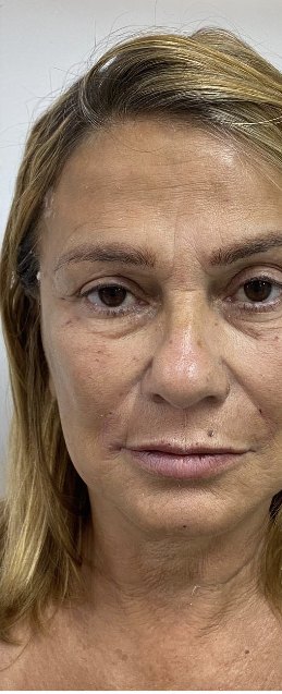 Depois do rejuvenescimento facial